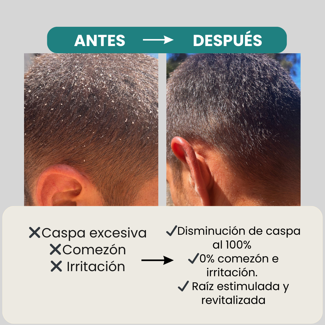 Kit Anticaspa 2 Shampoo +1 Acondicionador